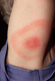 lyme bullseye